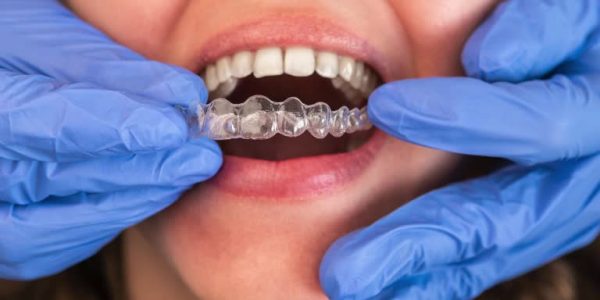 Dentist in gloves applying invisible aligner on female patient teeth at modern clinic. Orthodontic removable straighteners in dentist office. Dental treatment concept.